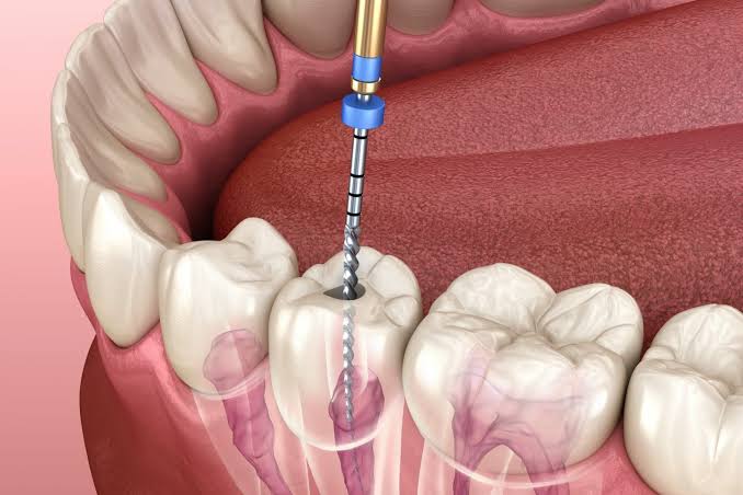 RCT Treatment in Mohali
